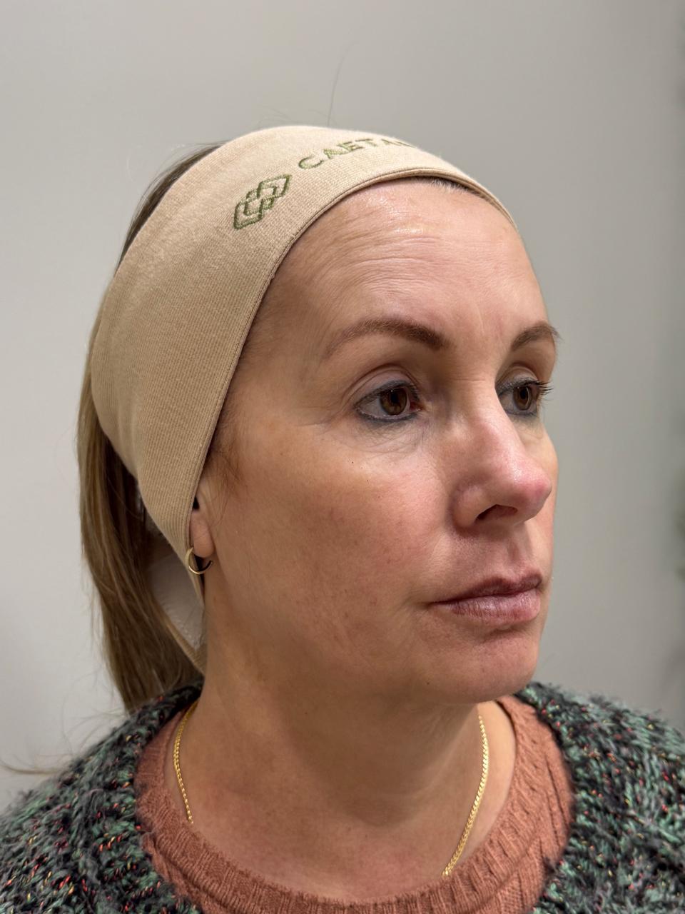 Caso 3: registro antes do cuidado facial