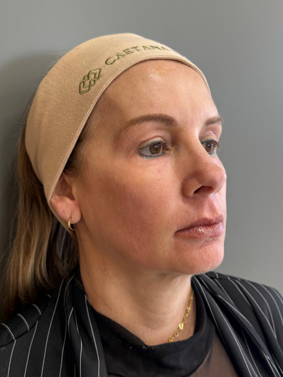 Caso 3: registro depois do cuidado facial