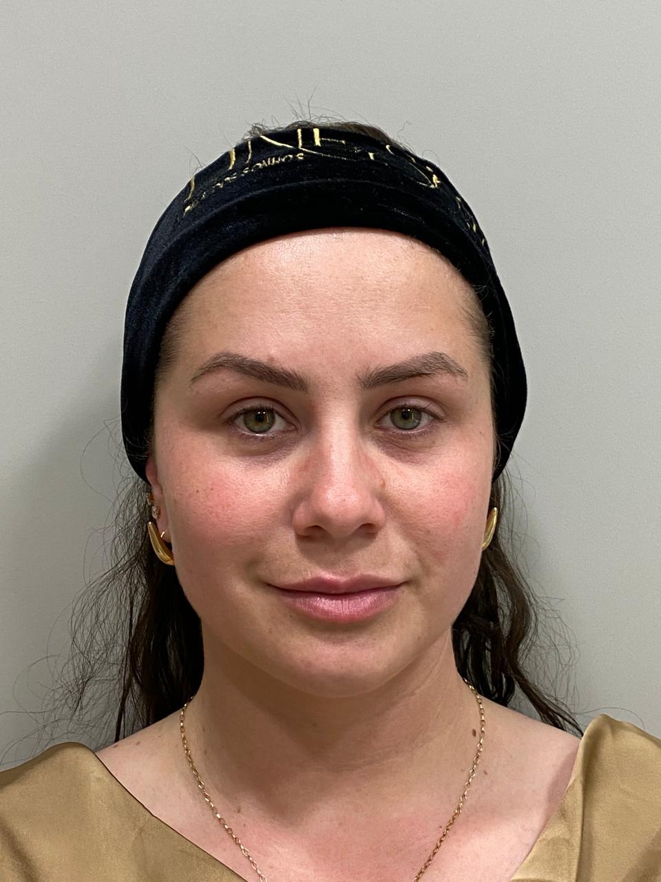 Caso 5: registro depois do cuidado facial