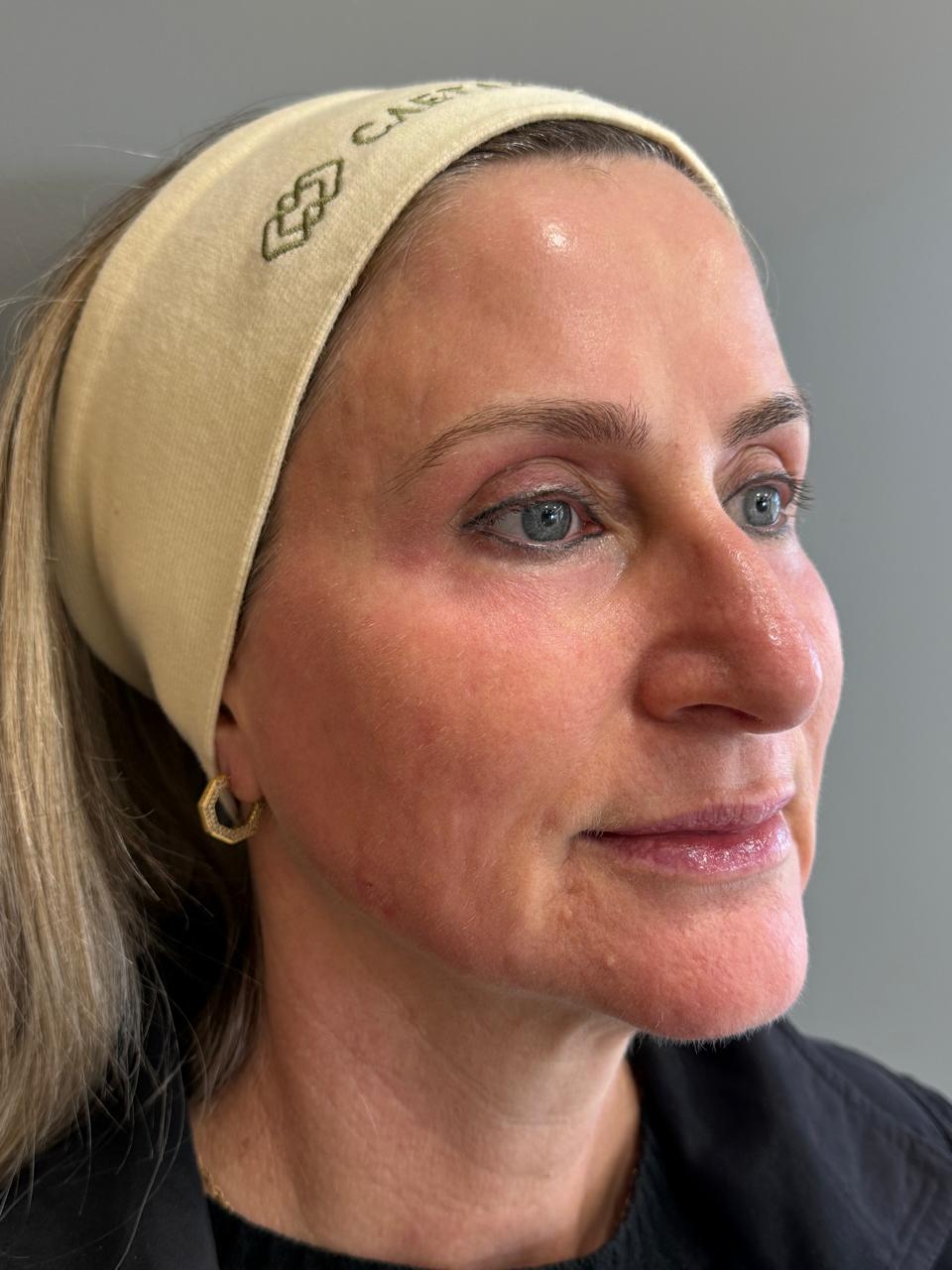 Caso 6: registro depois do cuidado facial