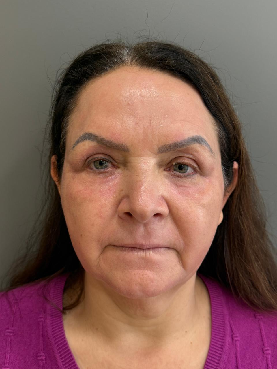 Caso 7: registro depois do cuidado facial